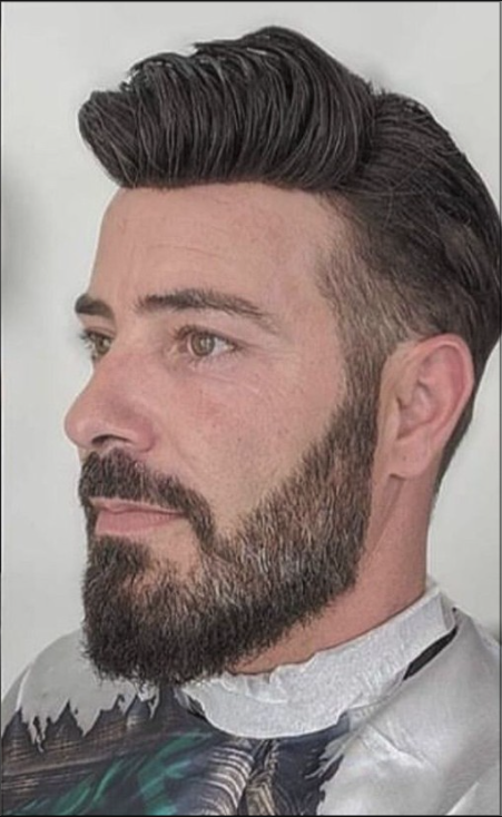 Before hair restoration