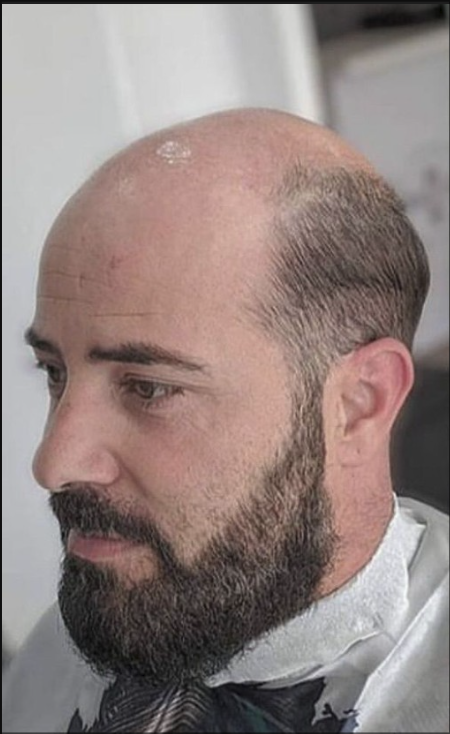 After hair restoration